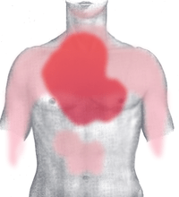 Порядок надання домедичної допомоги постраждалим  при підозрі на гострий інфаркт міокарда